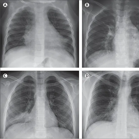 Viral Pneumonia